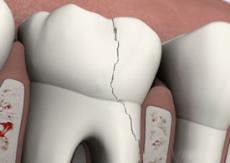 Fractured Cusp Fractured Cusp