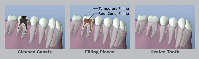 Root canal therapy