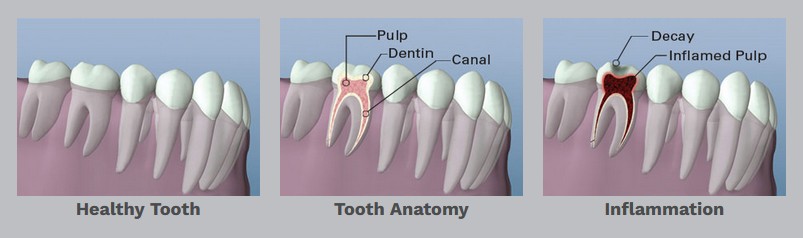 Root canal therapy