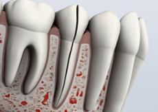 Split Tooth Split Tooth