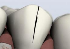 Treatable Cracked Tooth Treatable Cracked Tooth