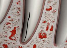 Vertical Root Fracture Vertical Root Fracture